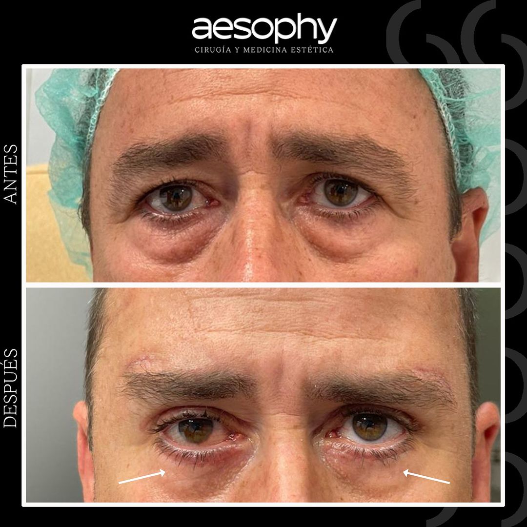 Blefaroplastia en Málaga: Cirugía para Eliminar Bolsas y Ojeras
