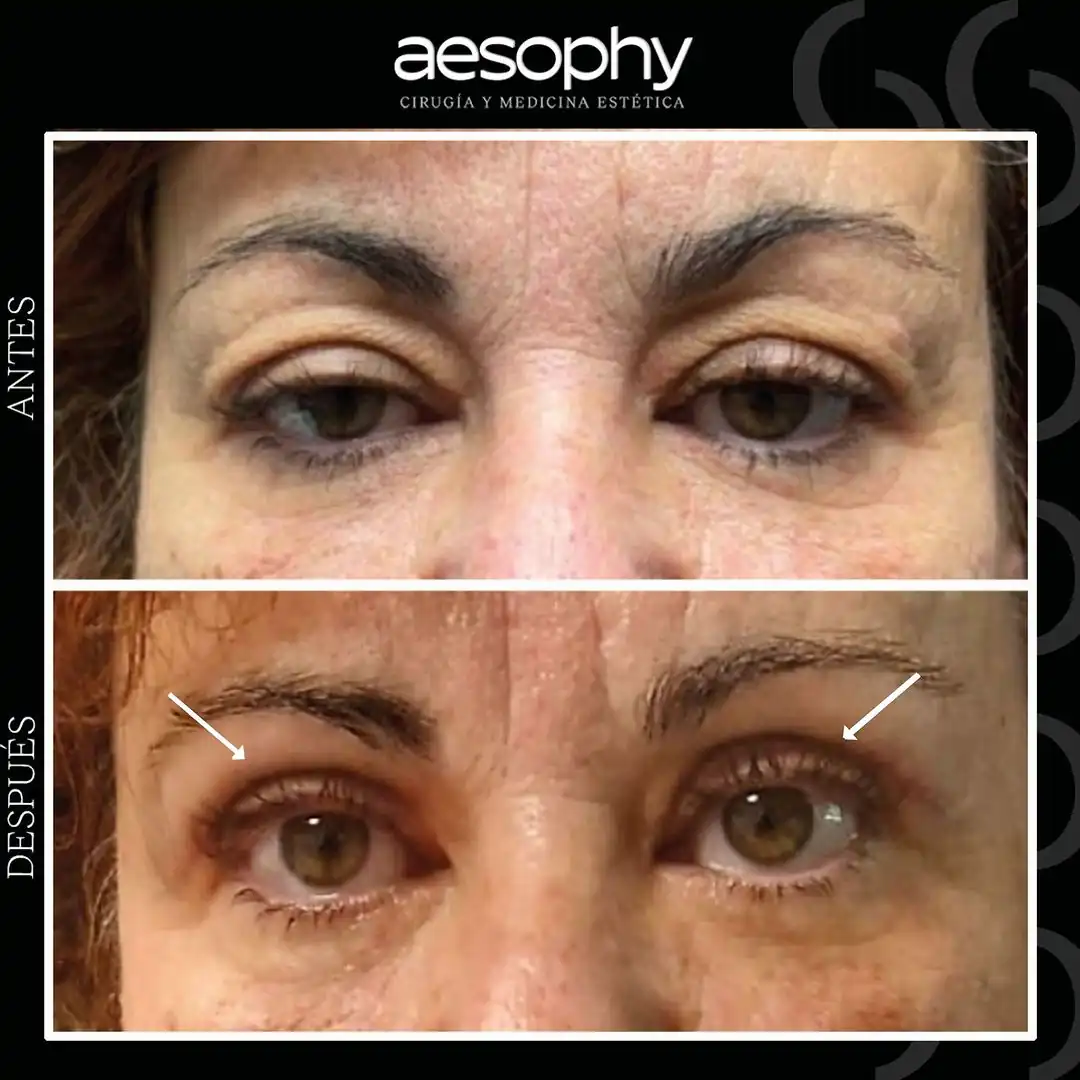 Blefaroplastia en Málaga: Cirugía para Eliminar Bolsas y Ojeras