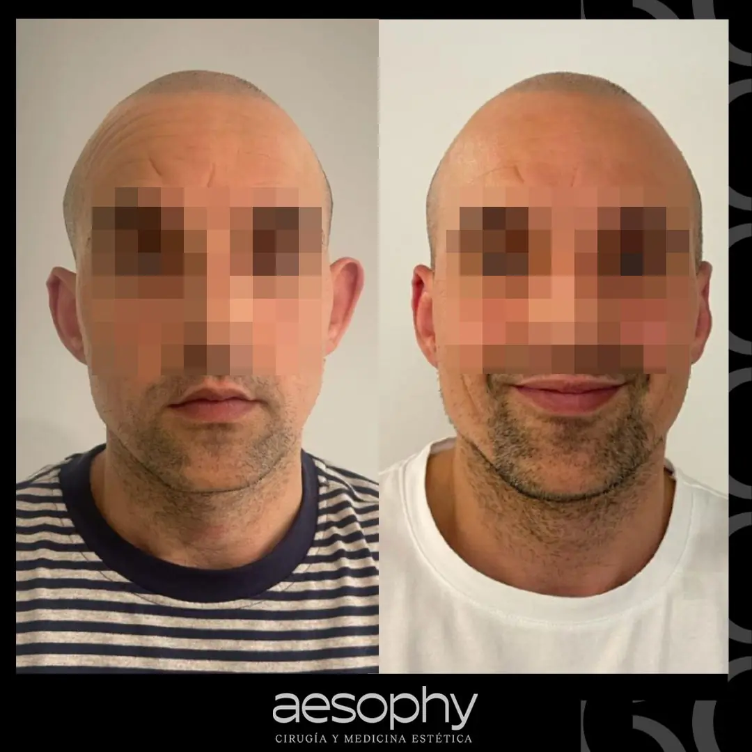 Otoplastia en Málaga: Recupera tu Confianza en Clínica Aesophy