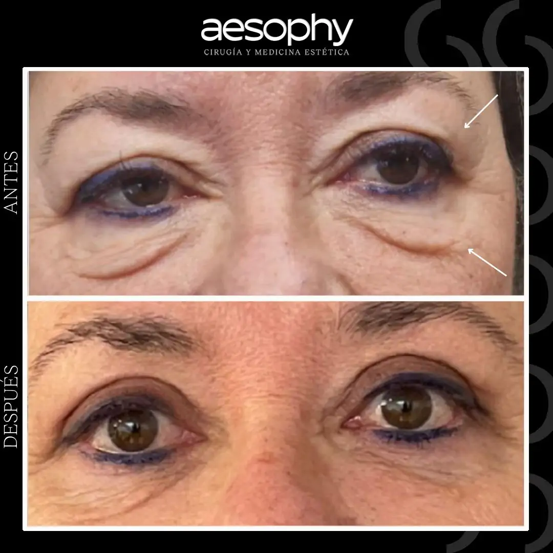 Blefaroplastia en Málaga: Cirugía para Eliminar Bolsas y Ojeras