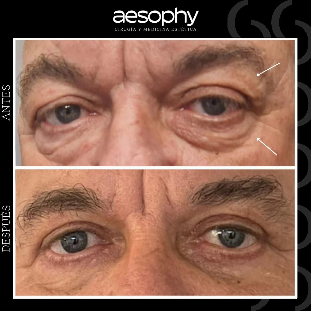 Blefaroplastia en Málaga: Cirugía para Eliminar Bolsas y Ojeras