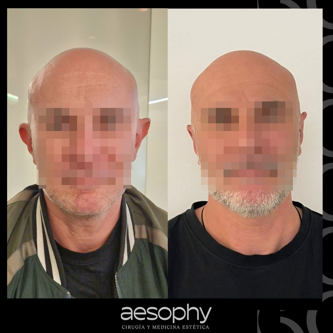 Otoplastia en Málaga: Recupera tu Confianza en Clínica Aesophy