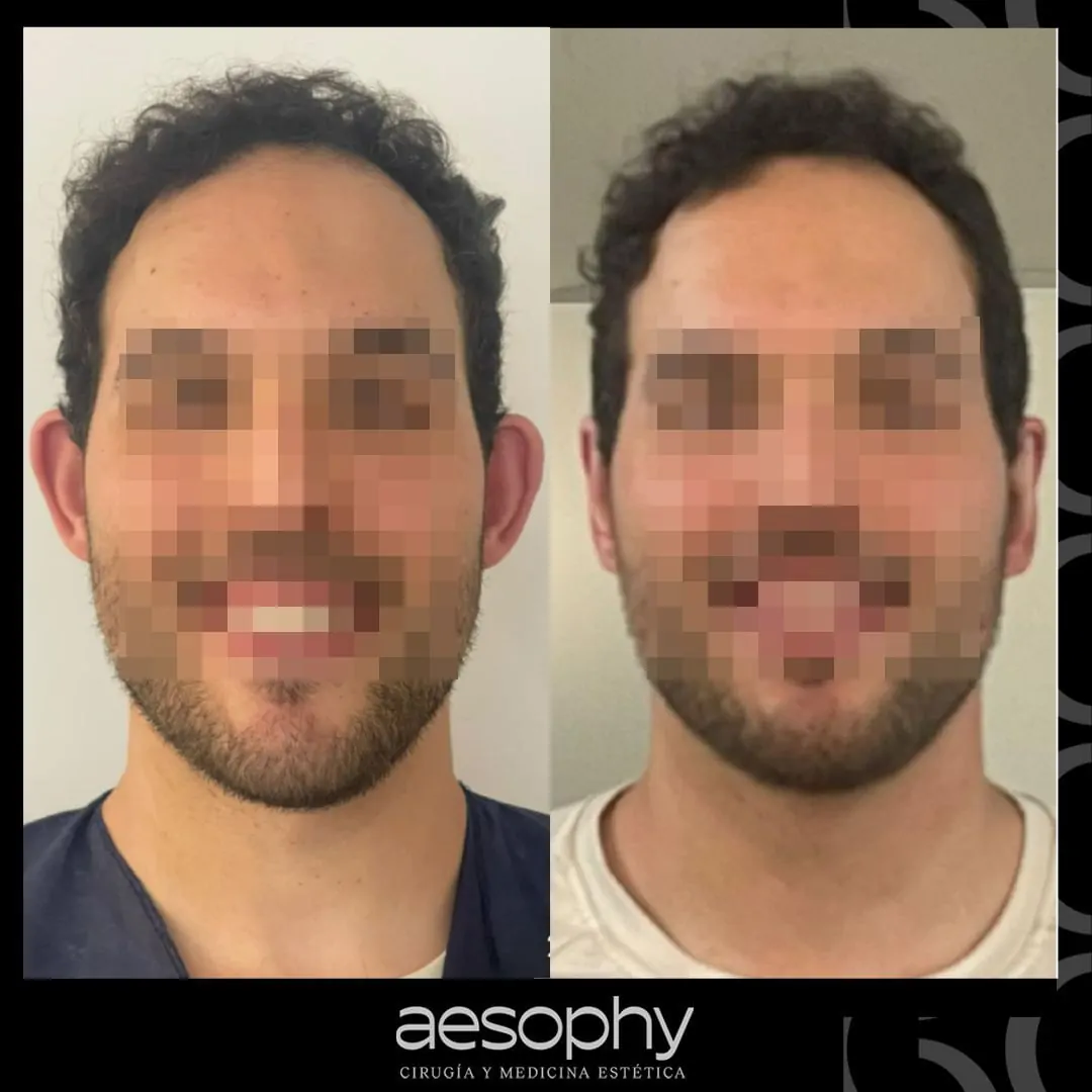 Otoplastia en Málaga: Recupera tu Confianza en Clínica Aesophy
